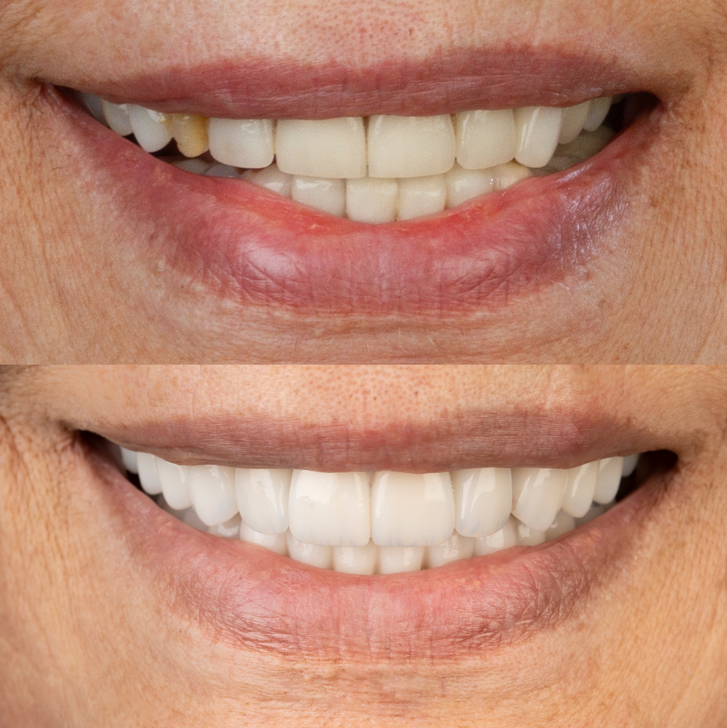 Patient smile transformation