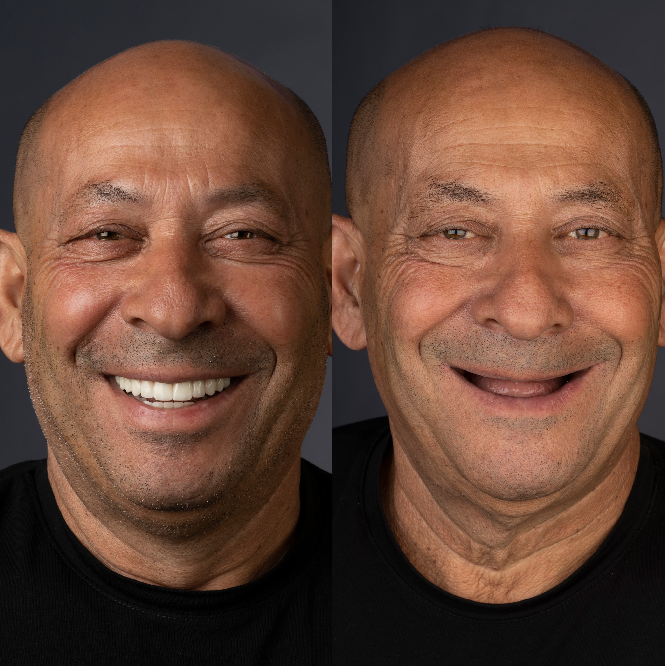 Patient smile transformation