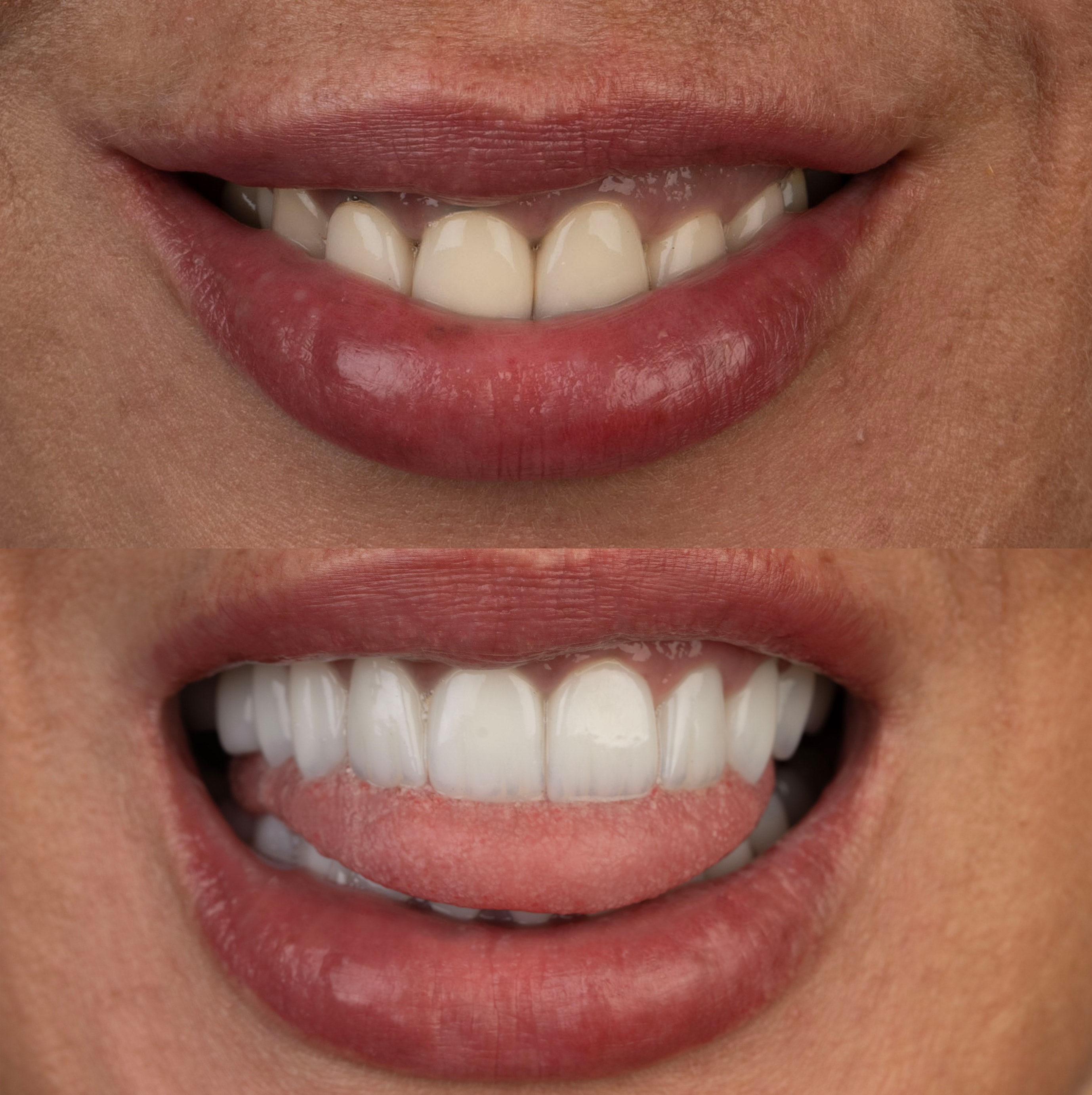 Patient smile transformation