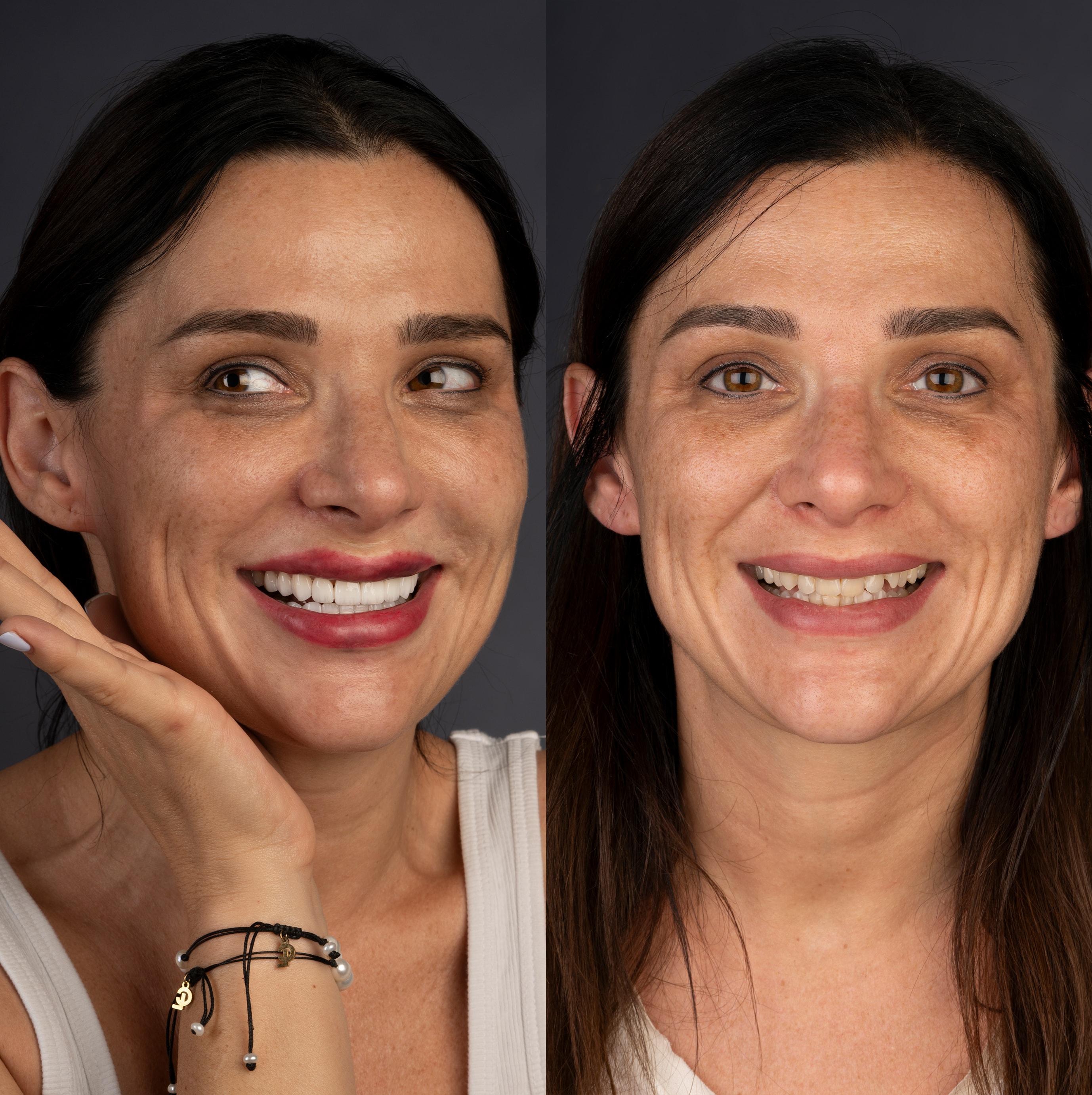 Patient smile transformation