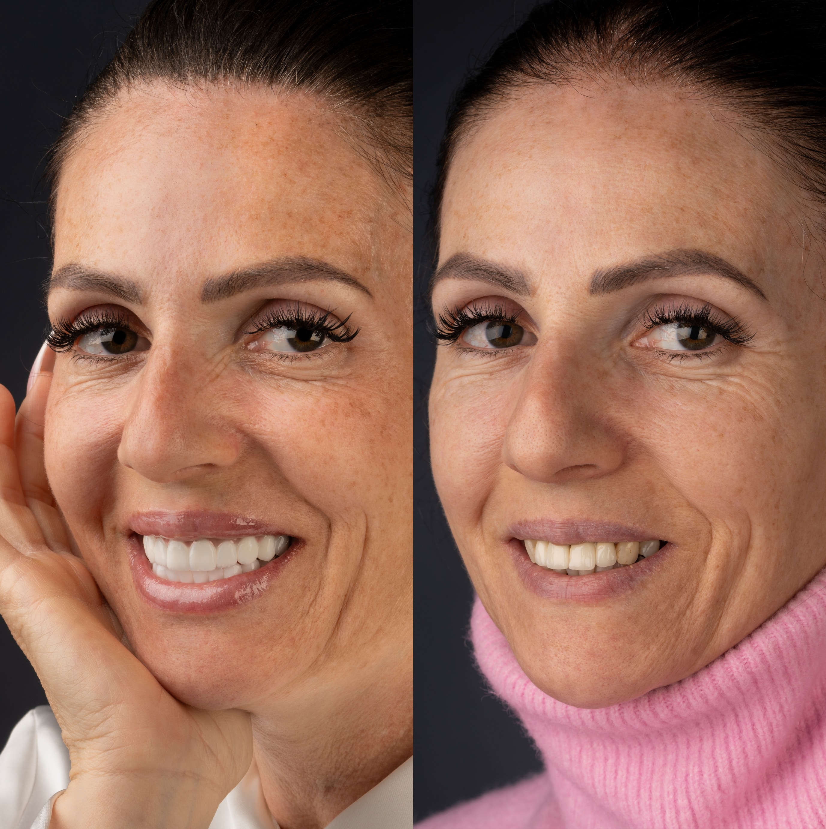 Patient smile transformation