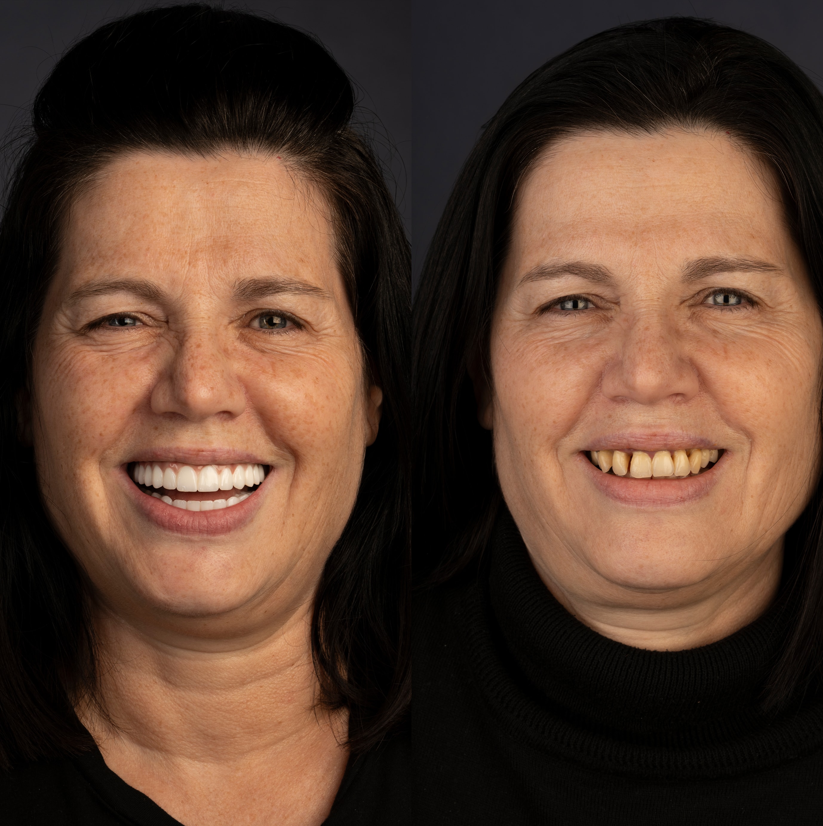 Patient smile transformation