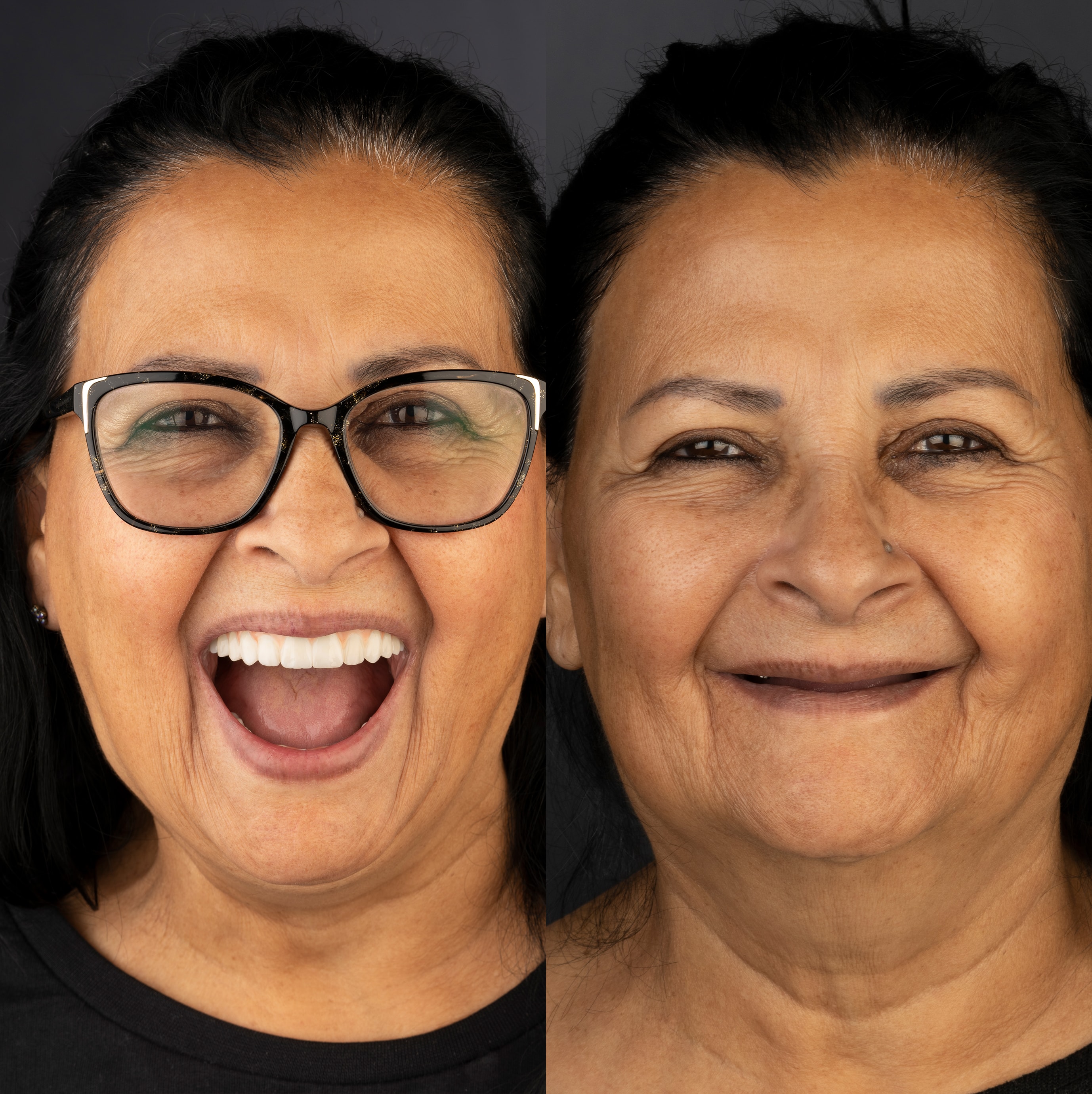 Patient smile transformation