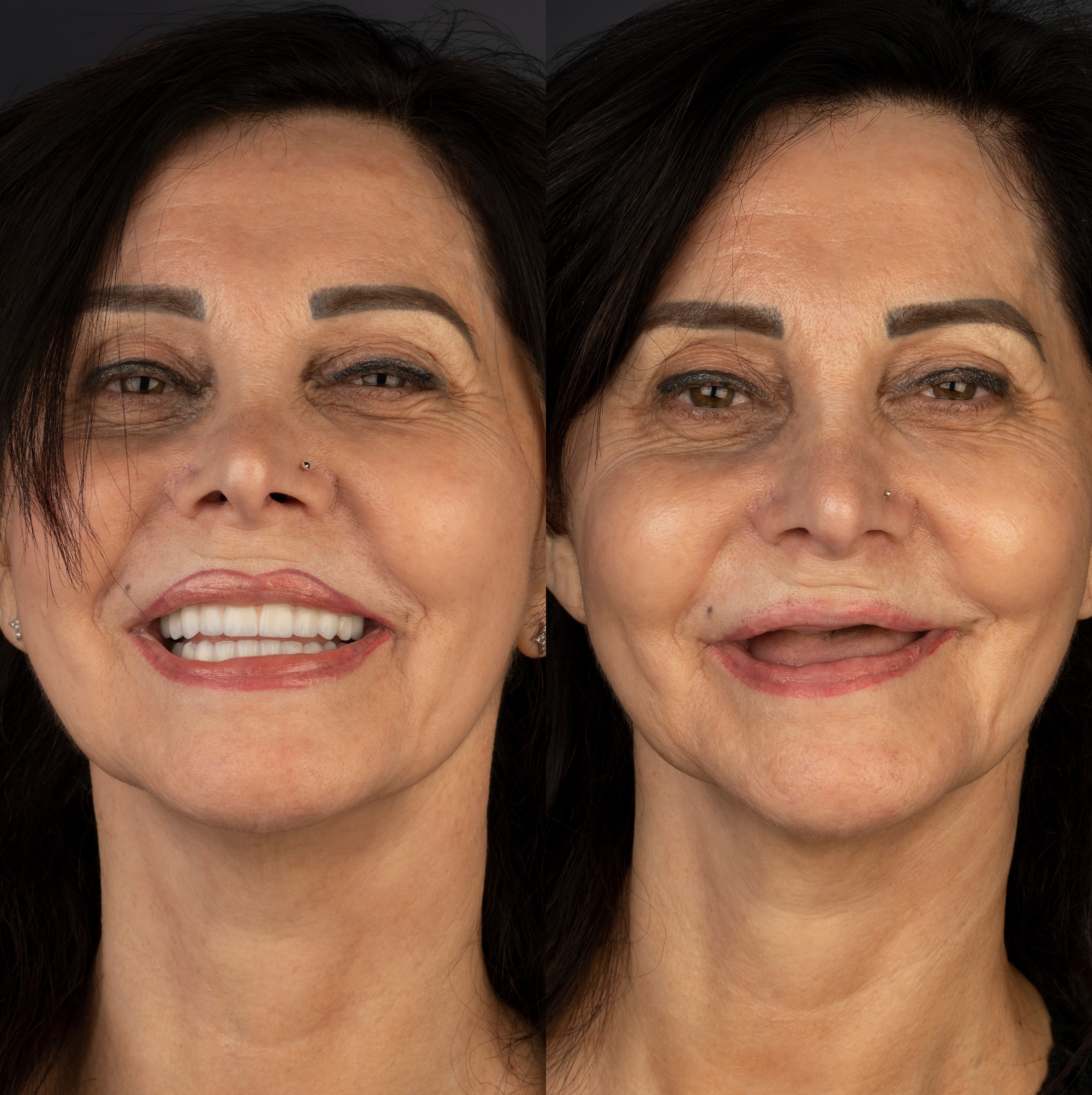 Patient smile transformation