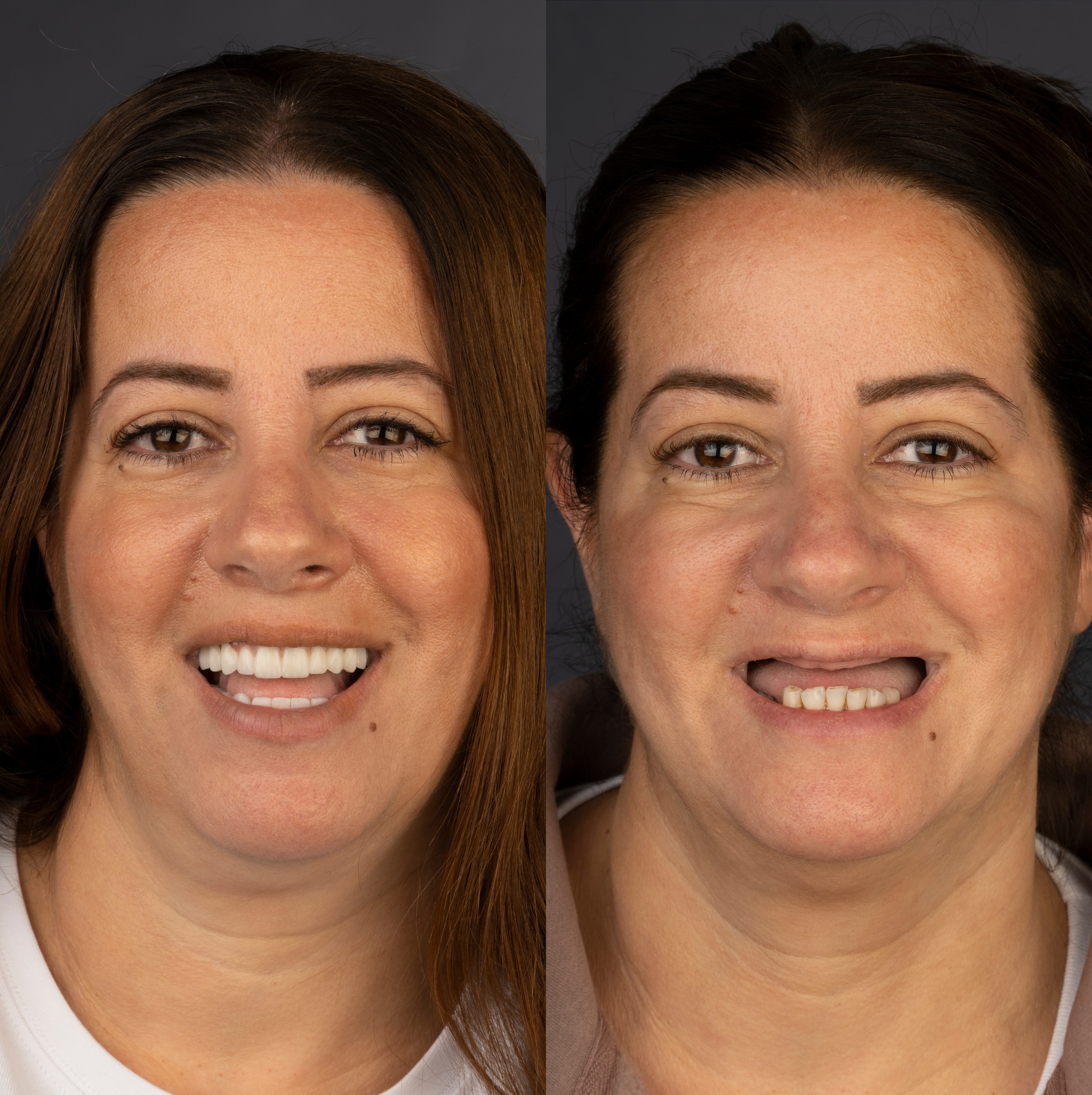 Patient smile transformation